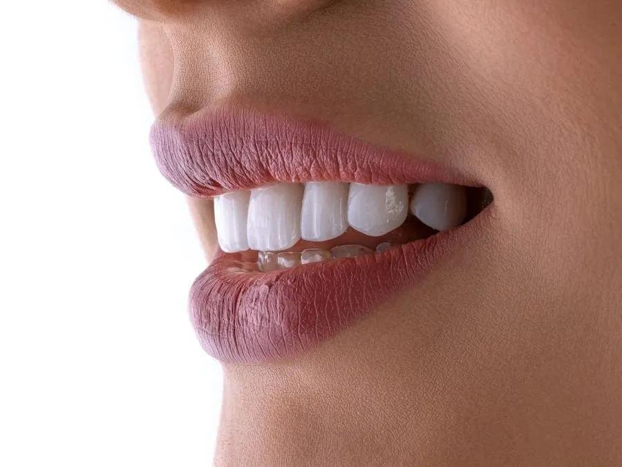Simulación del tono dental después del blanqueamiento