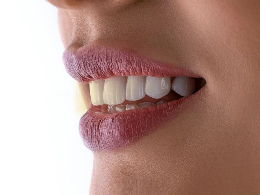 Simulación del tono dental antes del blanqueamiento