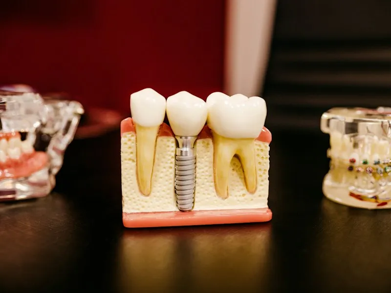 Modelo didáctico de implante dental con corona y estructura de soporte
