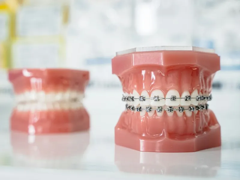 Modelo dental con brackets utilizado para explicar el tratamiento de ortodoncia