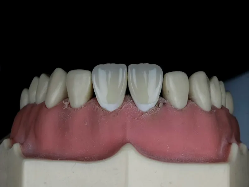 Detalle de dientes blancos y alineados tras un tratamiento de blanqueamiento